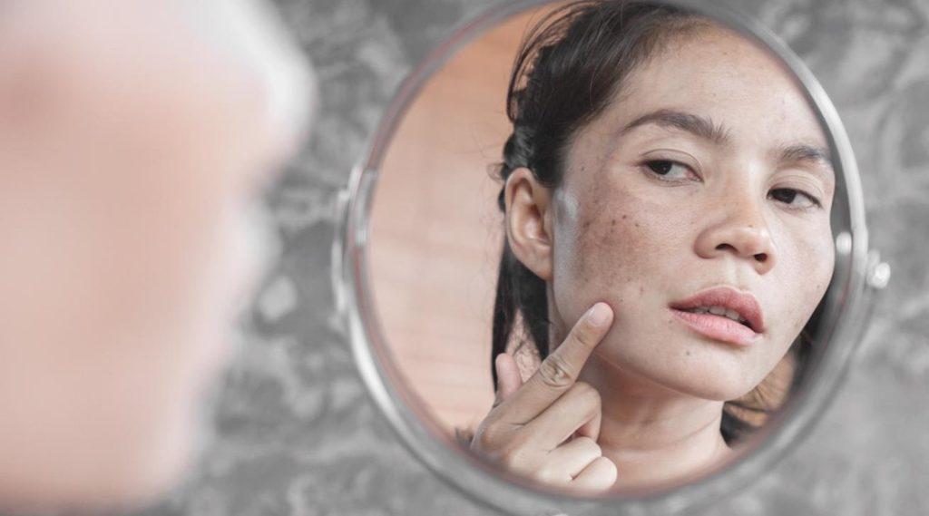 Tri-Luma Cream: Everything you should know