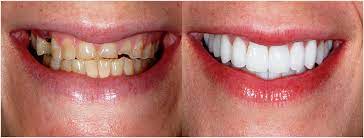 Veneers Treatment in Manchester: Achieving a Radiant Smile