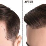 Rediscovering Confidence: The Definitive Guide to Hair Transplants in Islamabad