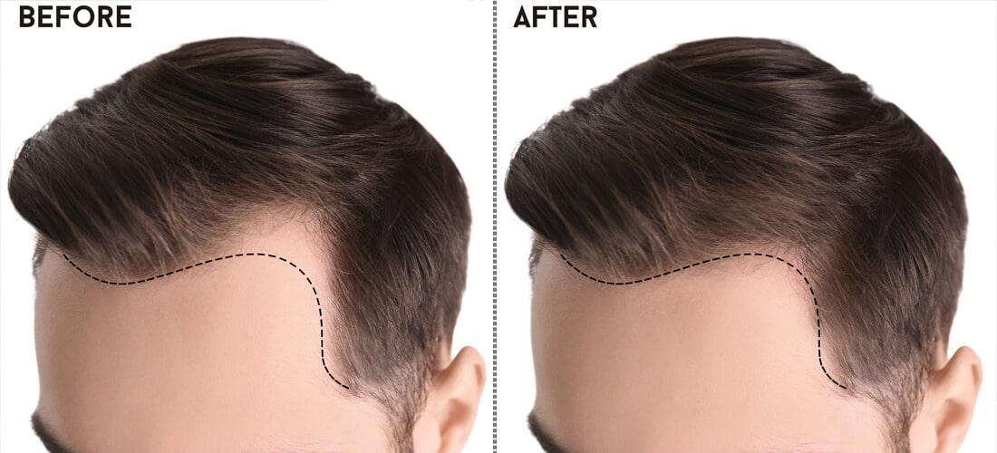 Rediscovering Confidence: The Definitive Guide to Hair Transplants in Islamabad