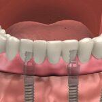 Explaining The Causes And Solutions Of Misaligned Teeth