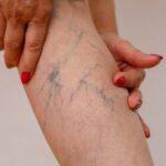 Are You Ready for Vein Treatment? Ask Yourself These Key Questions First
