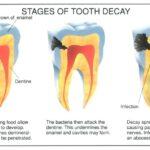 Myths and Facts About Teeth Whitening