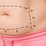 Aesthetic Evolution: Unlocking Beauty with Tummy Tuck Surgery and the Impact of Chin Augmentation