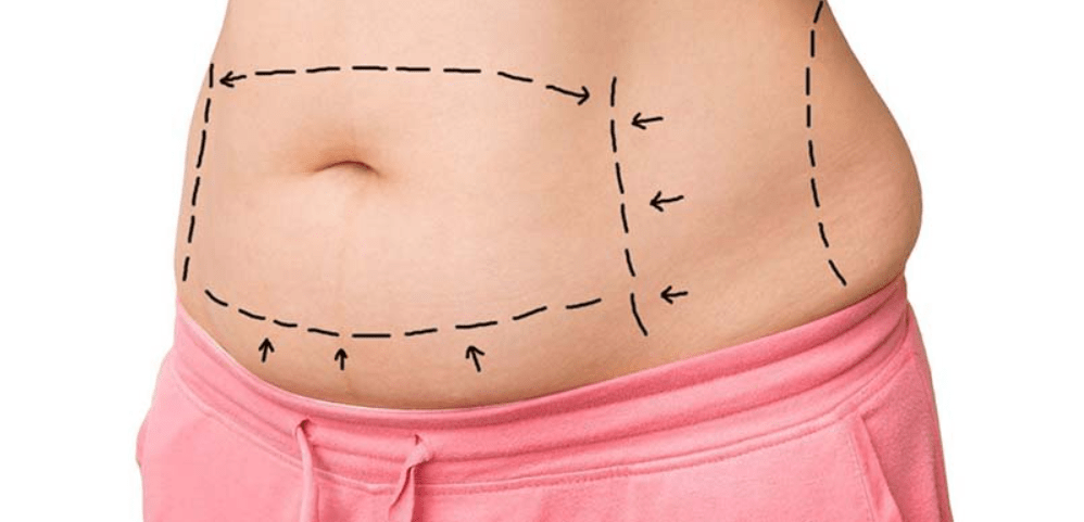 Aesthetic Evolution: Unlocking Beauty with Tummy Tuck Surgery and the Impact of Chin Augmentation