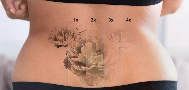 Say Goodbye to Regrets: Tattoo Removal in Sydney