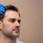 6 Things to Expect After Hair Transplant