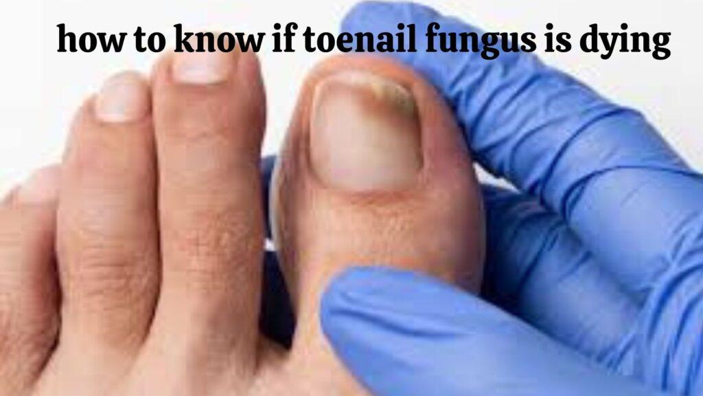 Find out how to know if toenail fungus is dying…