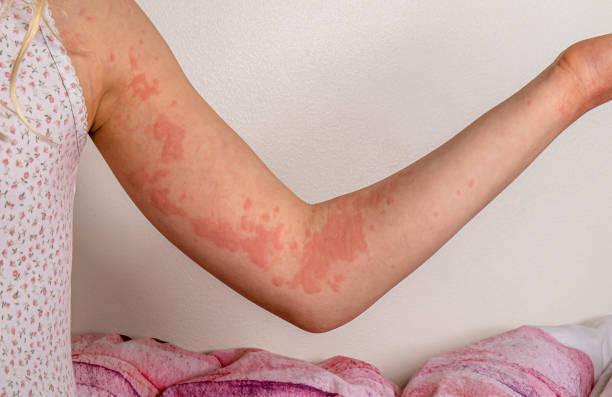 What is the most effective treatment for a skin infection?
