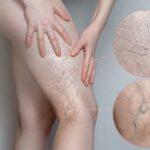 Unmasking the Secrets of Spider Veins: What Your Vascular Lesions Are Trying to Tell You