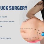 Benefits of a Tummy Tuck After a C-Section