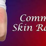 What are the causes and solutions of skin rashes?